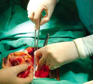 An organ transplant in process