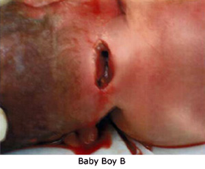 A baby's slit neck