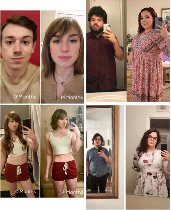 Bodily changes for MTF transgenders from feminizing hormones