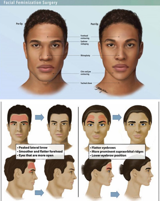 Examples of facial surgery procedures for transgenders