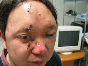 Dr. Peter Yuan Li after being attacked and robbed in his home
