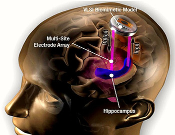 brain implant chip